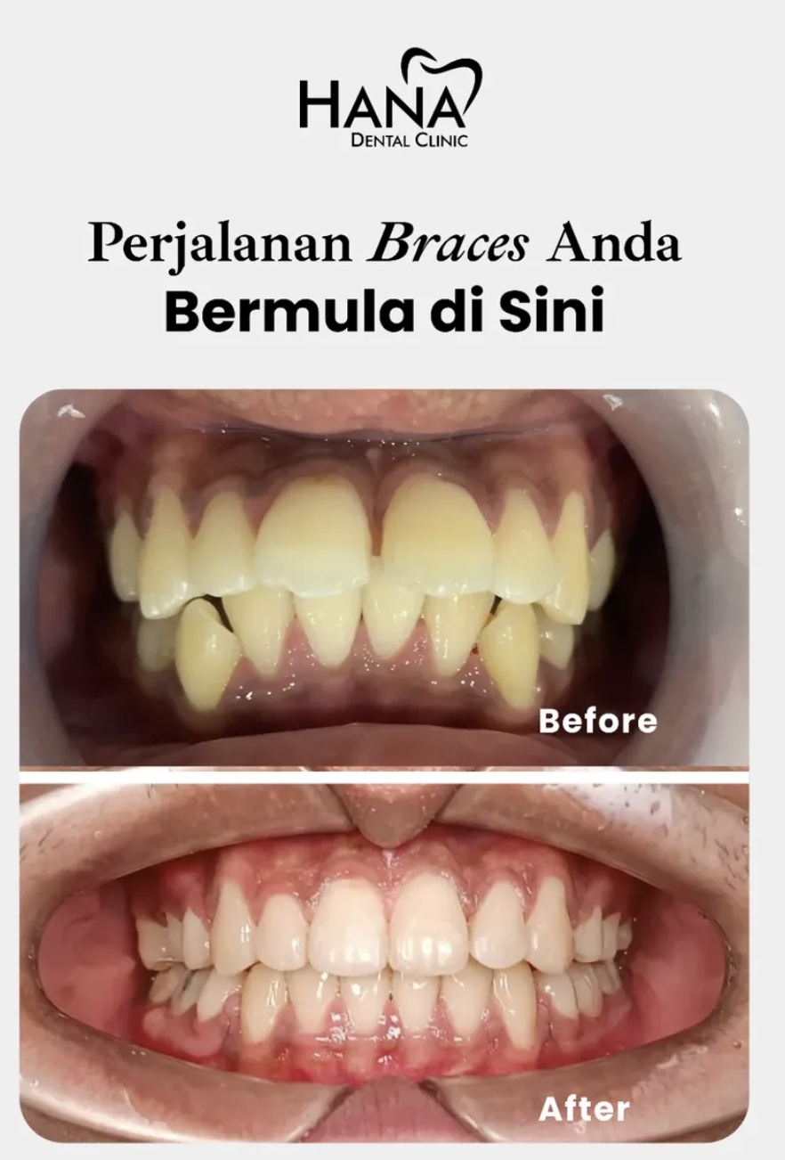 Braces Kawat Gigi